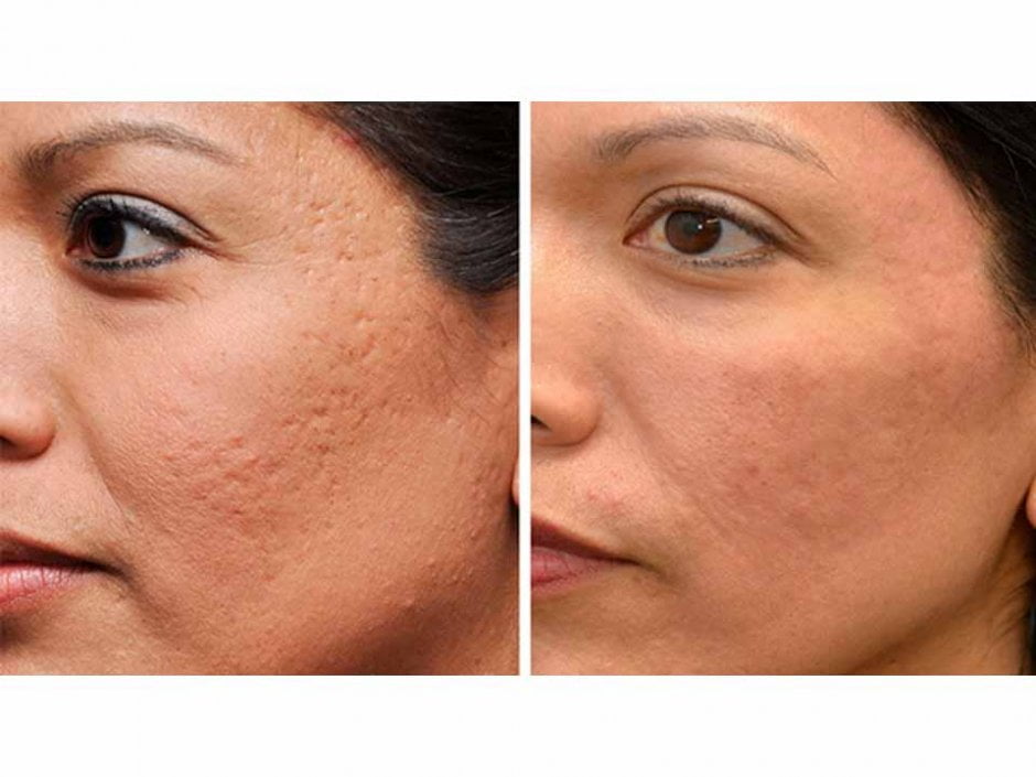 Elos-Sublative-acne-littekens