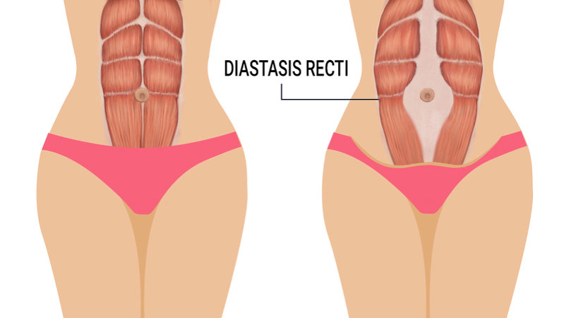 Diastase rectie na zwangerschap