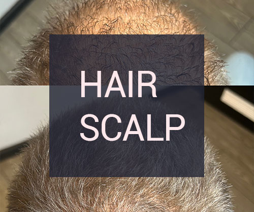 Hair Scalp/ Micro Hair Pigmentation