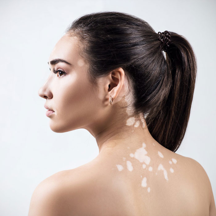 Medisch pigmenteren Vitiligo